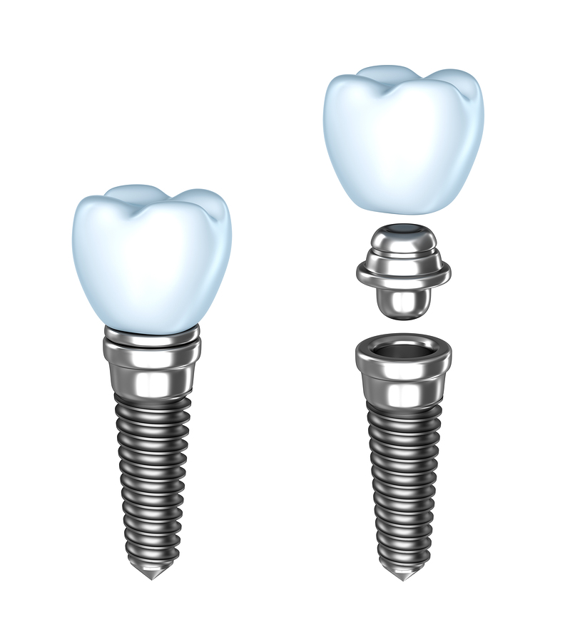 Dental Implants in Sterling, VA